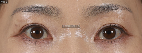 큰 쌍꺼풀 재수술
