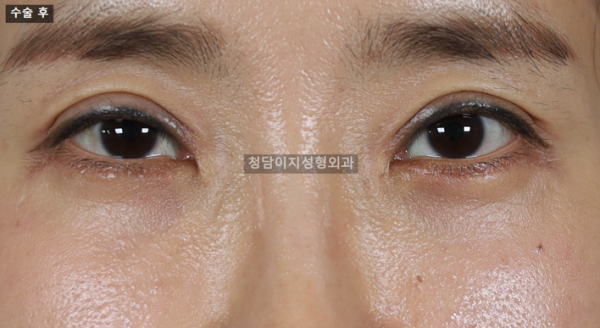 리프팅하안검성형술