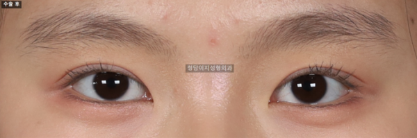 절개쌍꺼풀+눈매교정
