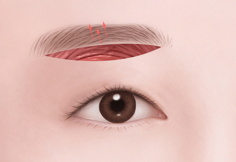 늘어진 피부 제거 일러스트