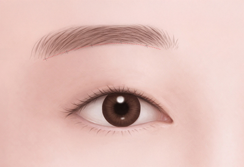 3중 섬세 봉합 일러스트