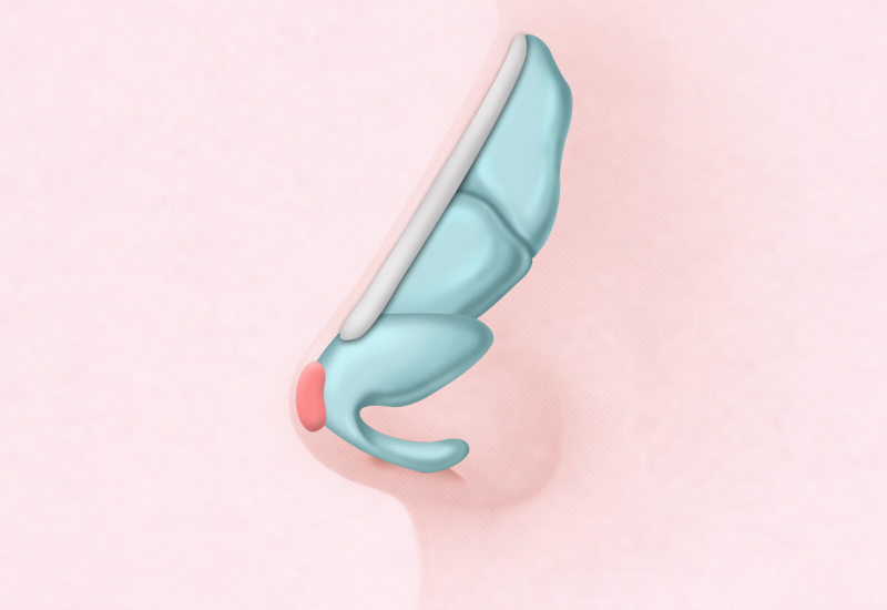 낮은코 케이스 2